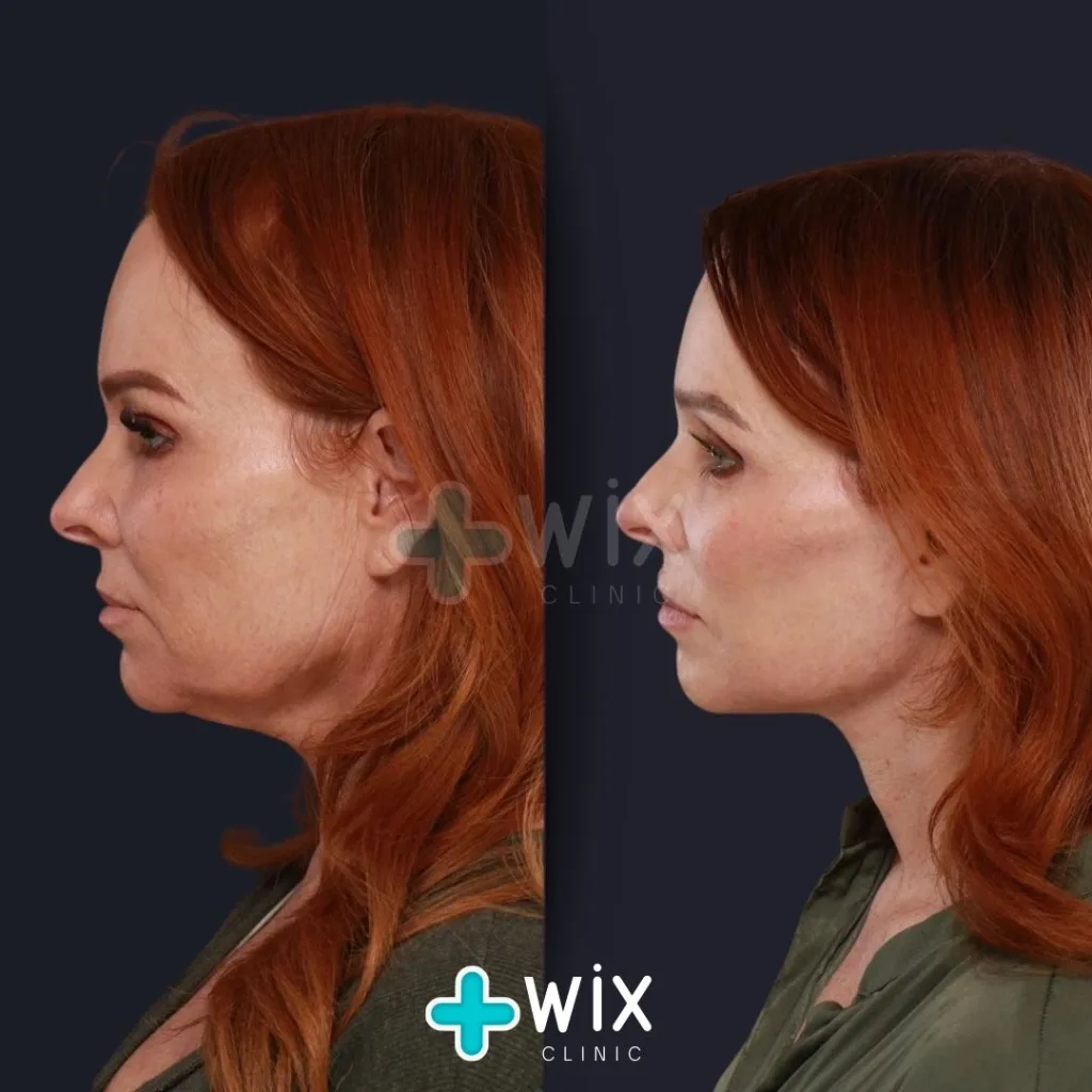 Forehead Reduction before and after