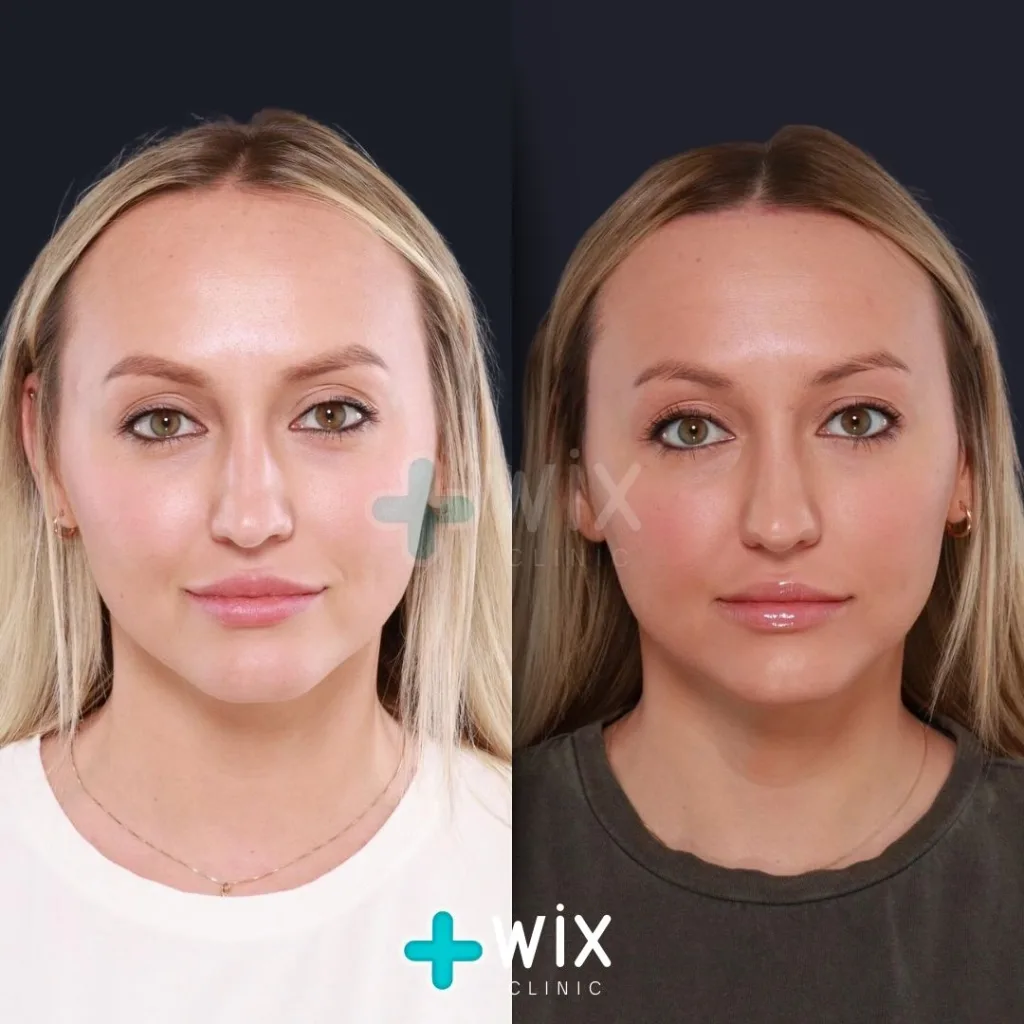 Forehead Reduction Before and After