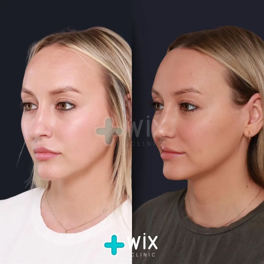 Forehead Reduction Before and After