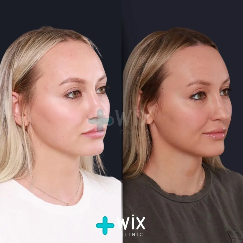 Forehead Reduction Before and After