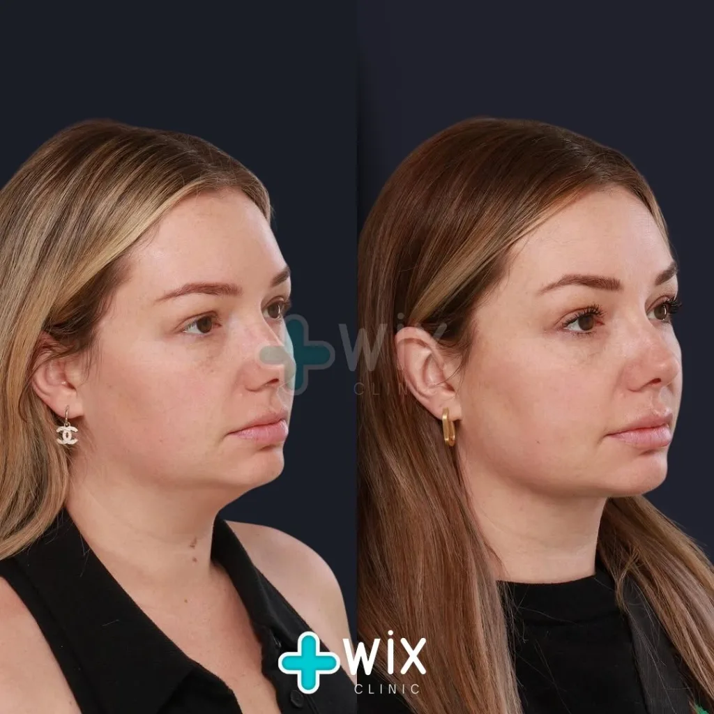 Forehead Reduction Before and After