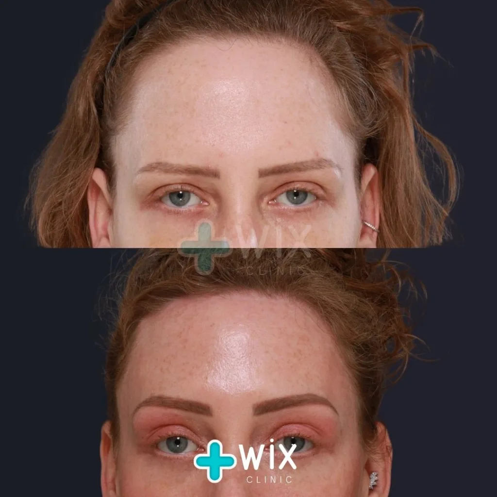 Forehead Reduction Before and After