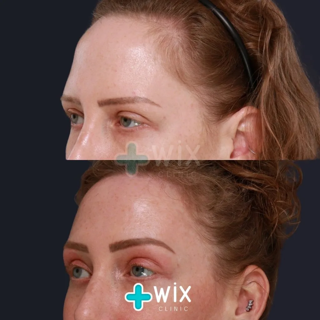 Forehead Reduction Before and After