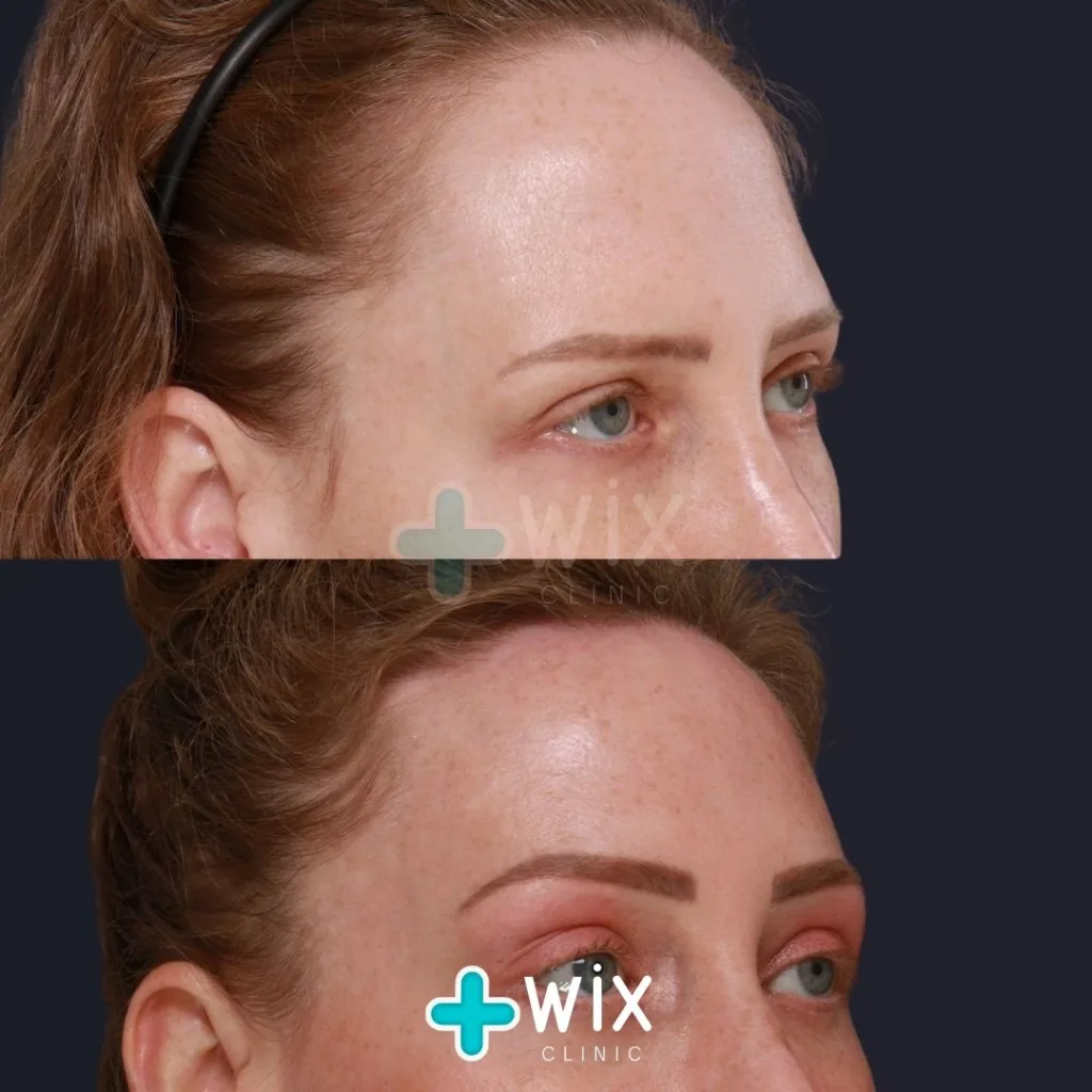 Forehead Reduction Before and After