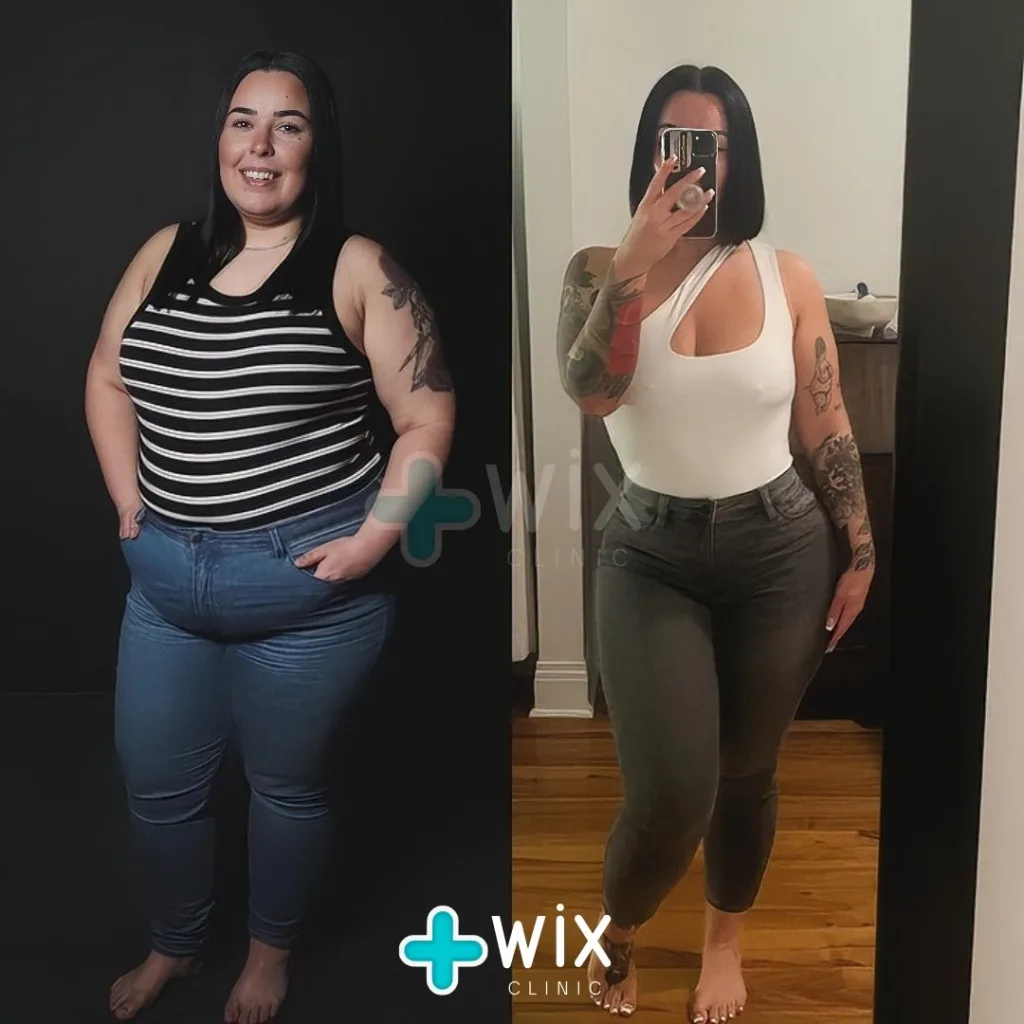 Gastric Sleeve Before and After 