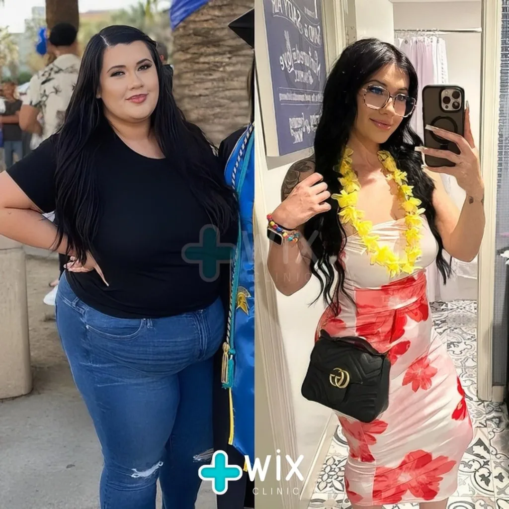 Gastric Sleeve Before and After 