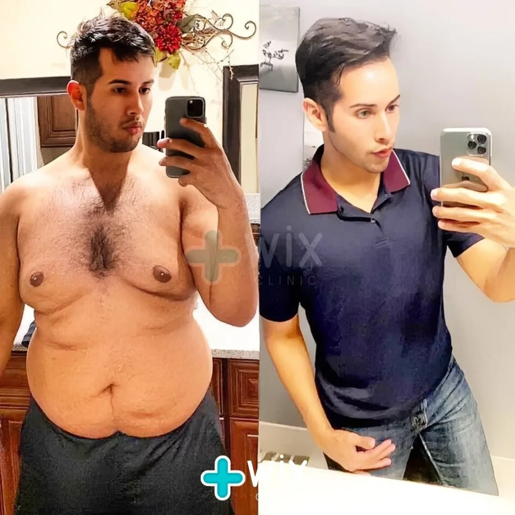 Gastric Sleeve Before and After 