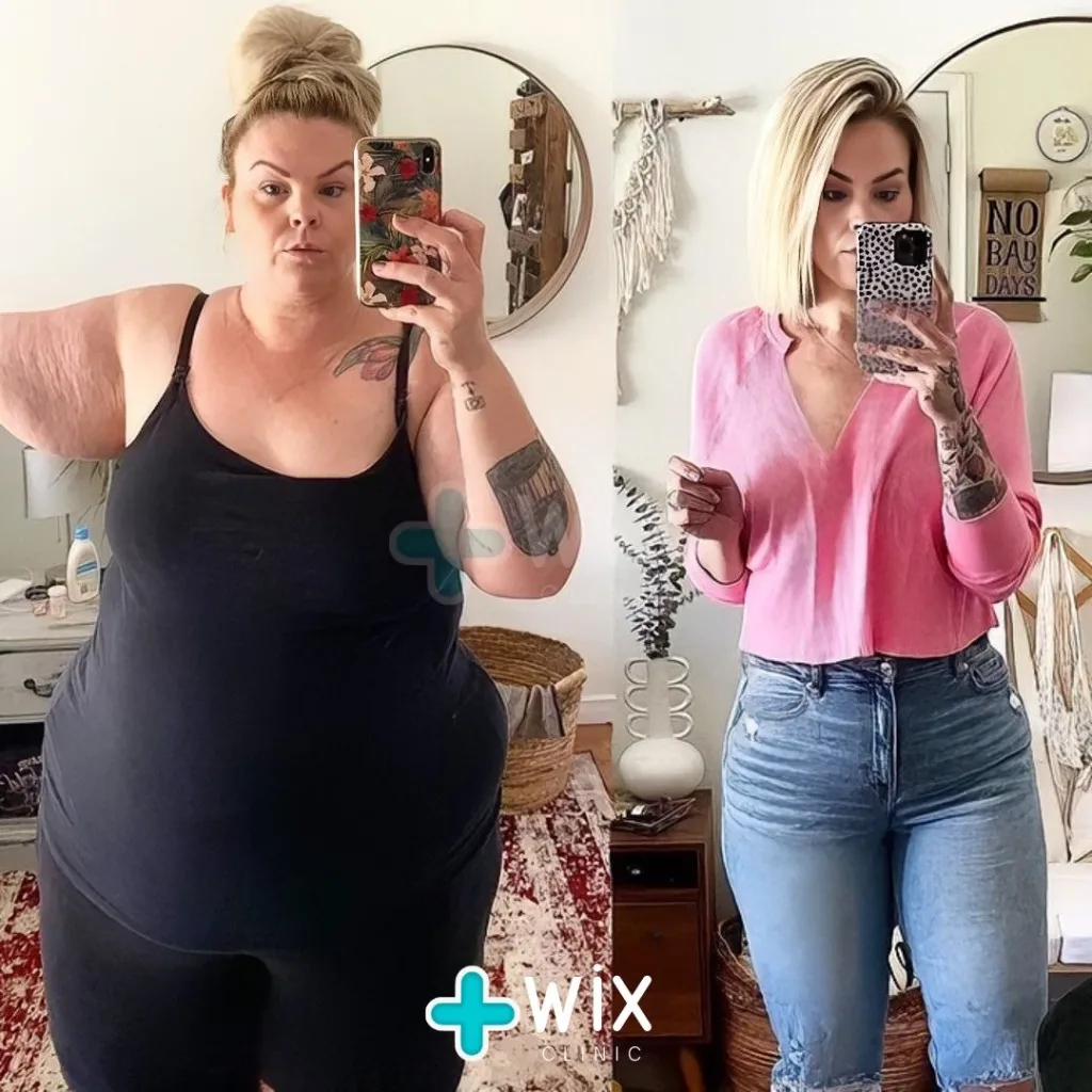 Gastric Sleeve Before and After 