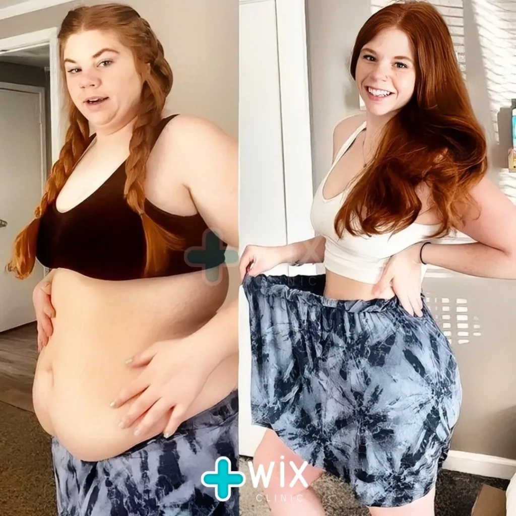 Gastric Sleeve Before and After 