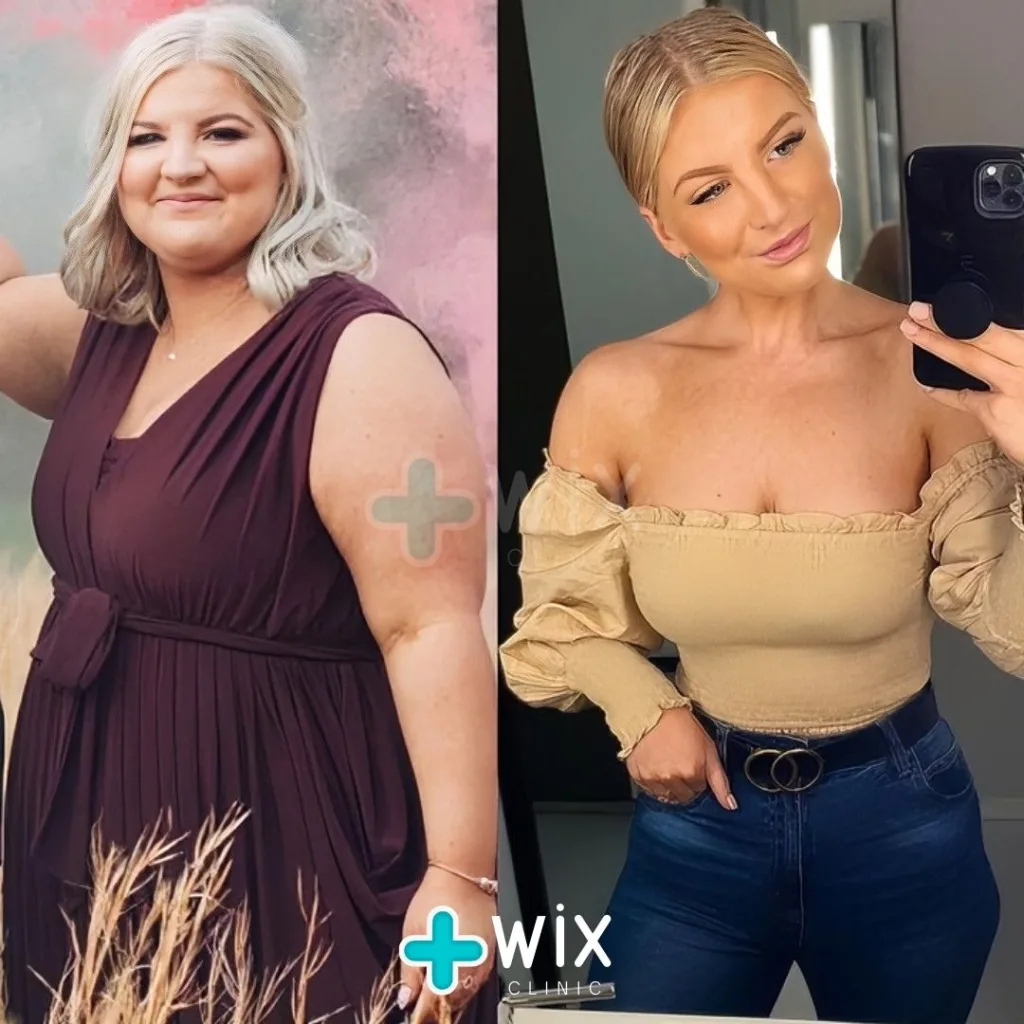 Gastric Sleeve Before and After 