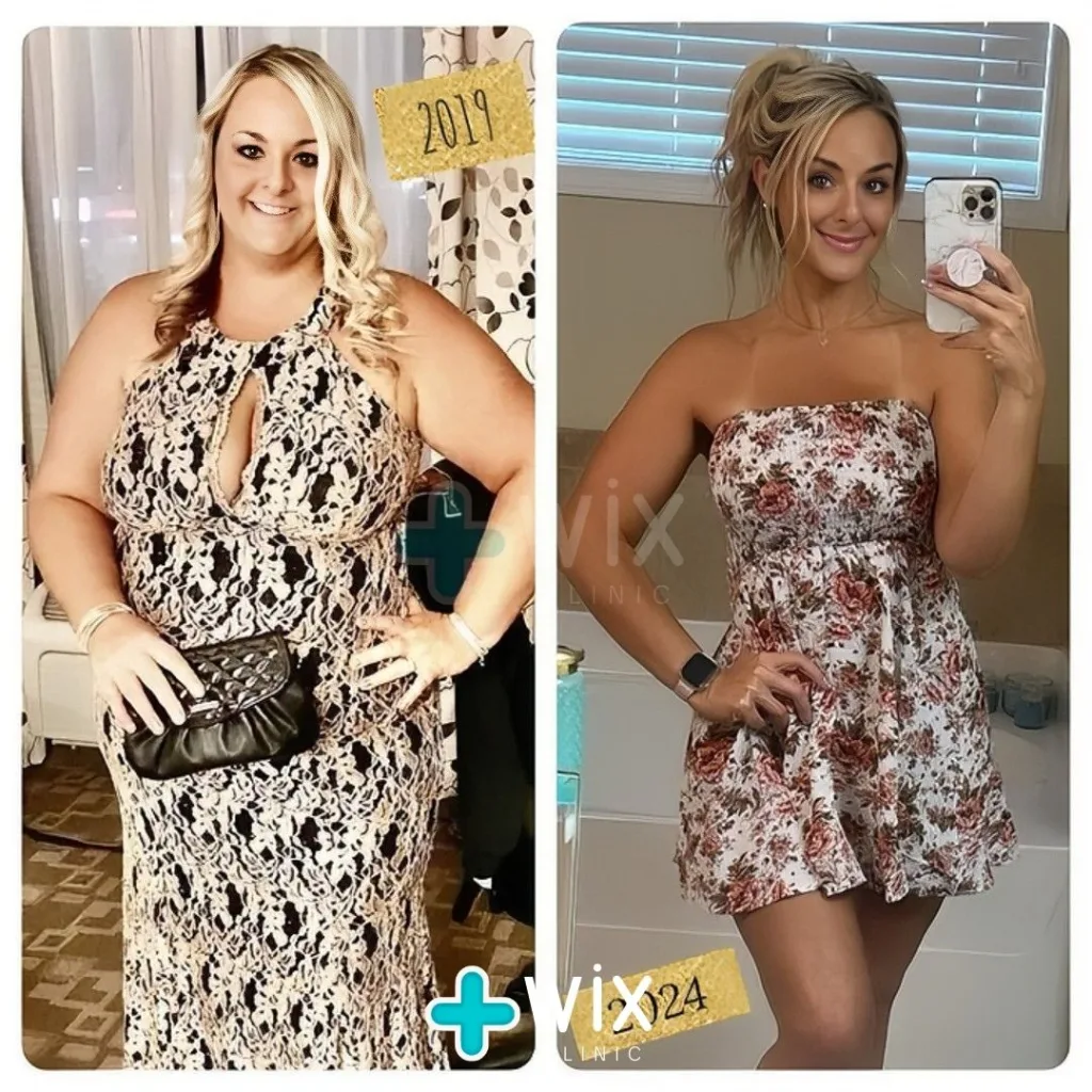 Gastric Sleeve Before and After 