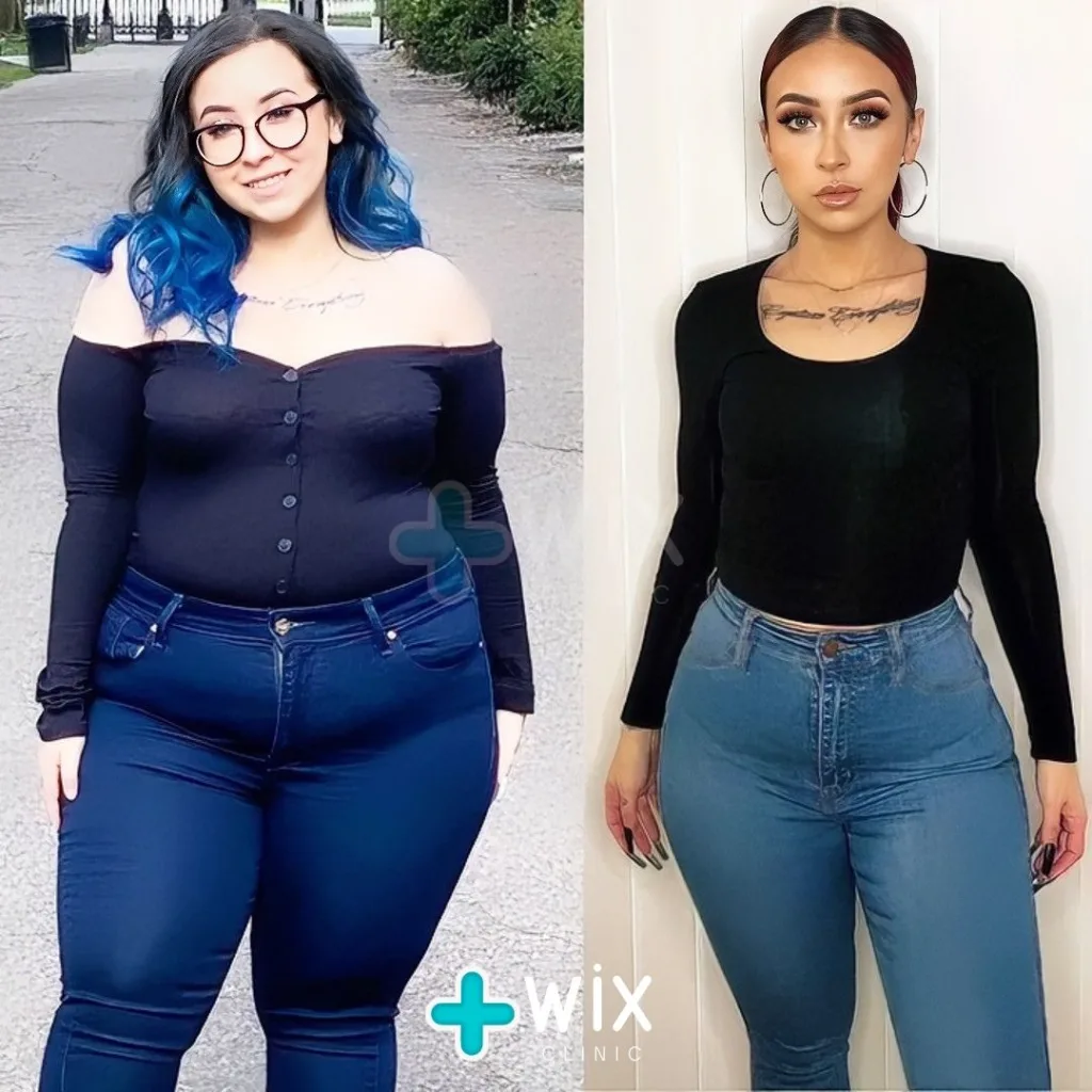 Gastric Sleeve Before and After 