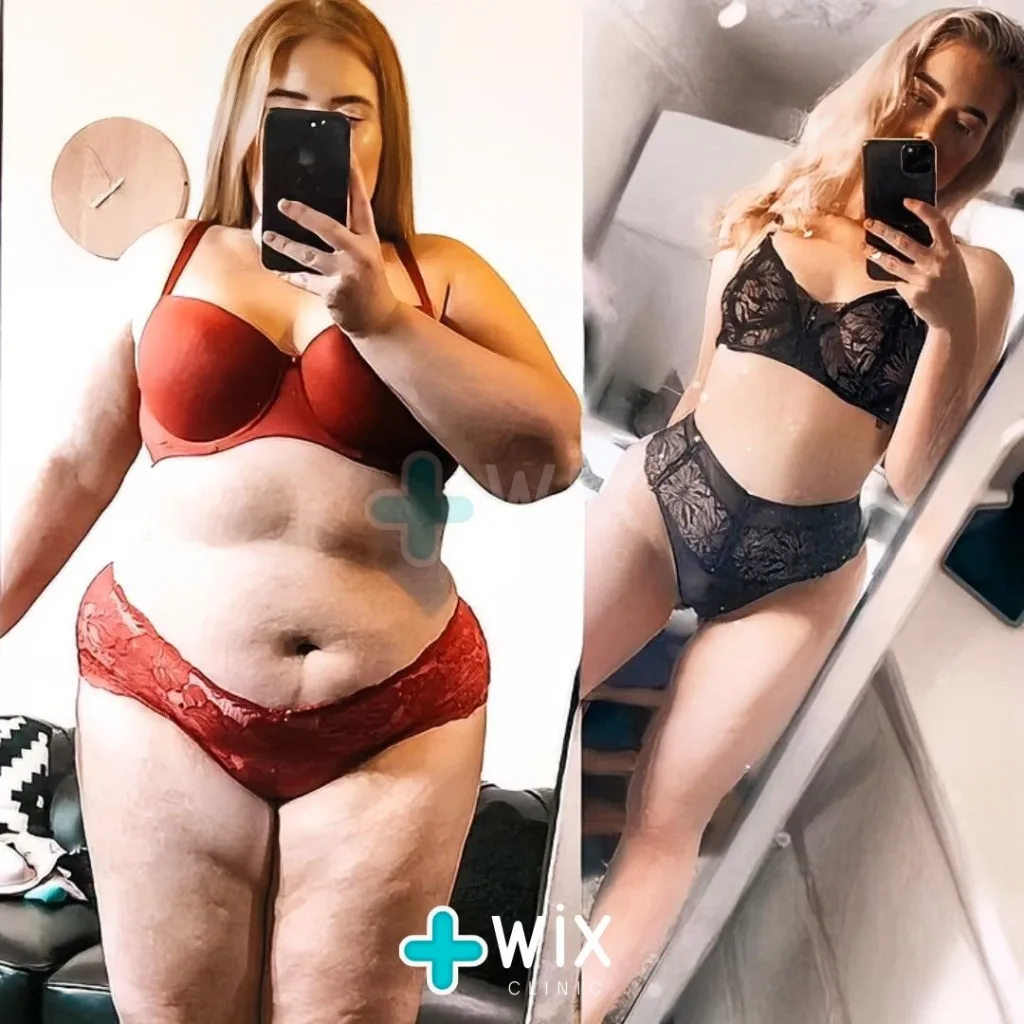 Gastric Sleeve Before and After 