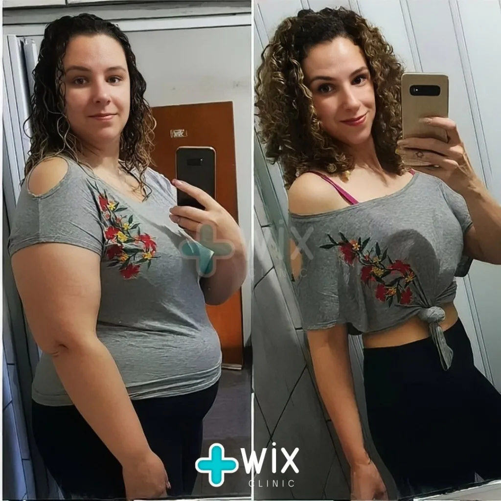 Gastric Sleeve Before and After 