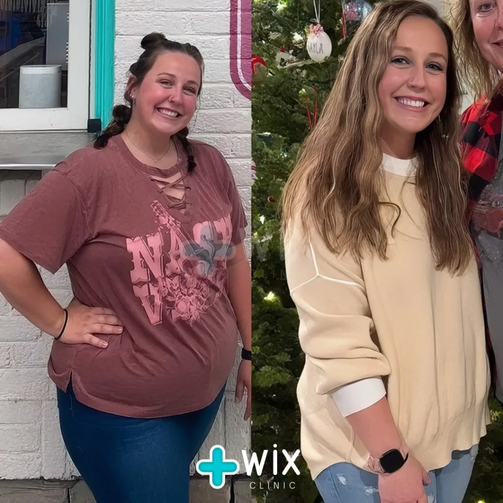 Gastric Sleeve Before and After 