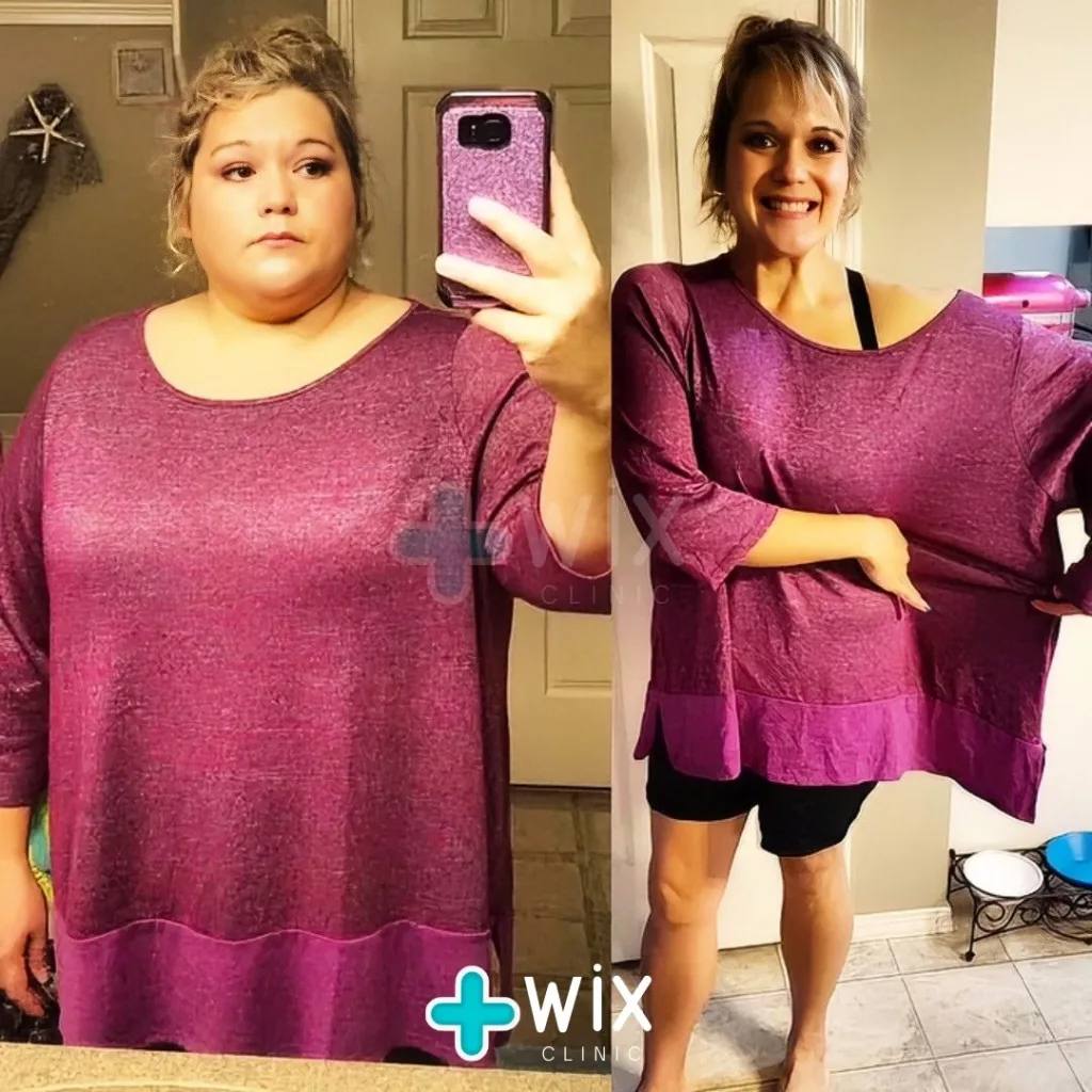 Gastric Sleeve Before and After 