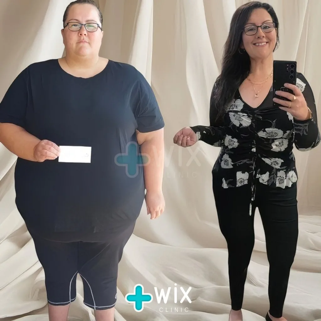 Gastric Sleeve Before and After 