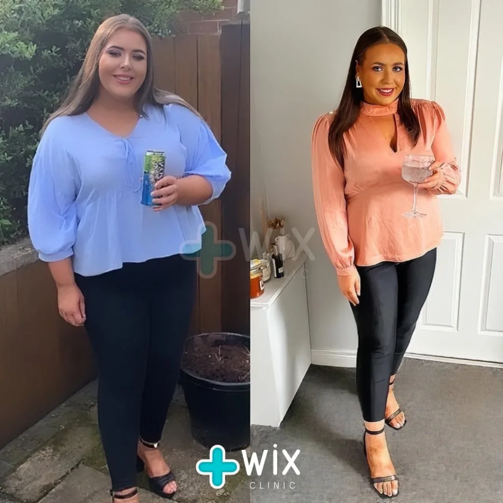 Gastric Sleeve Before and After 