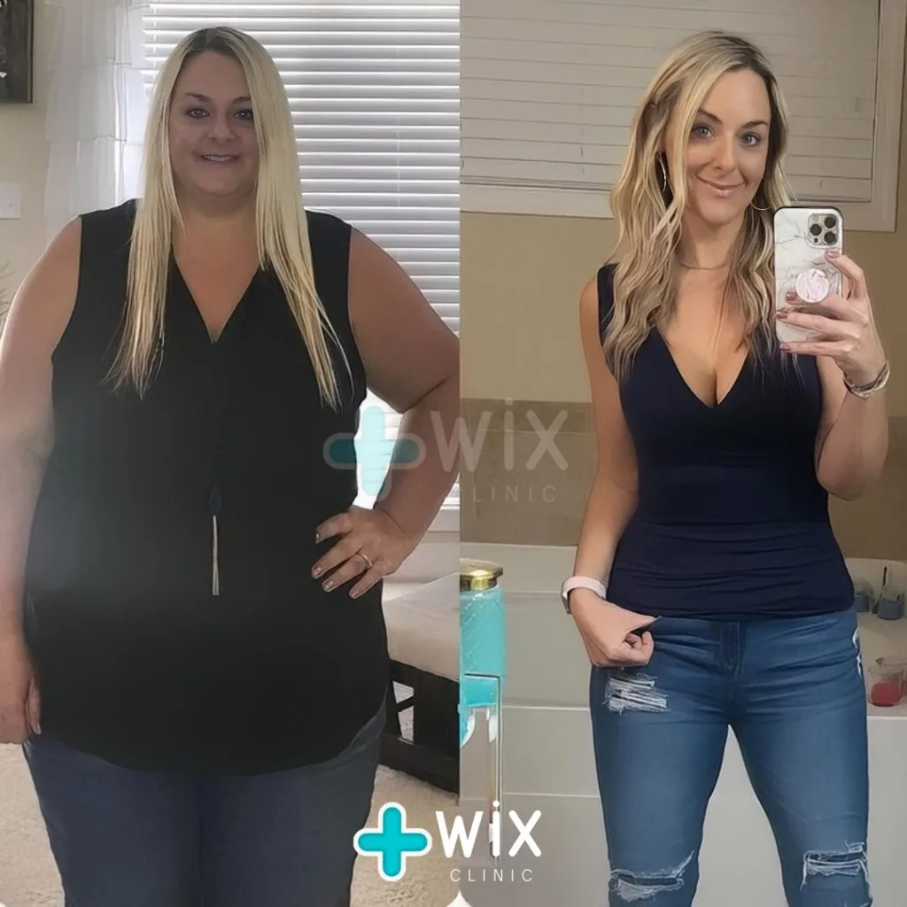 Gastric Sleeve Before and After 