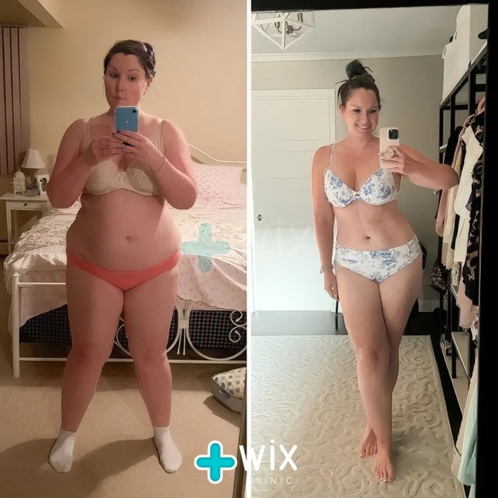 Gastric Sleeve Before and After 