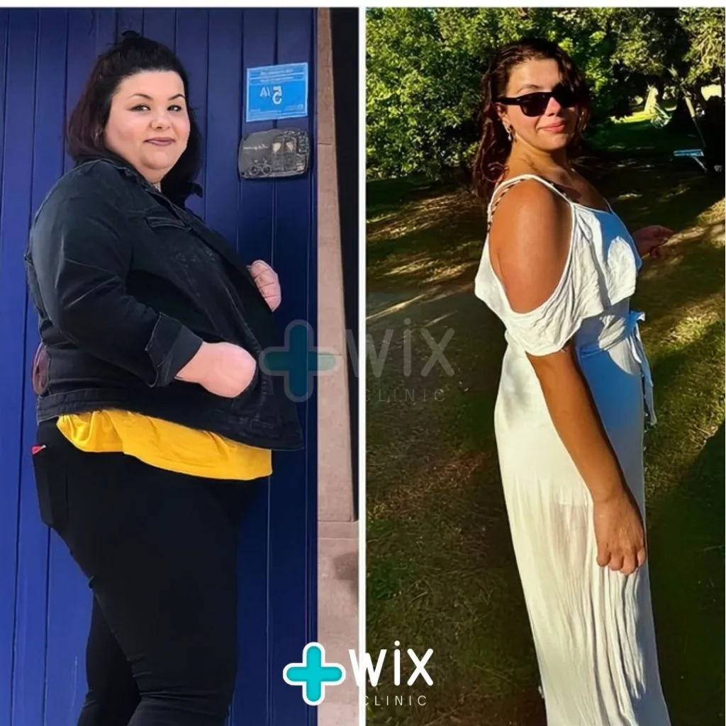 Gastric Sleeve Before and After 