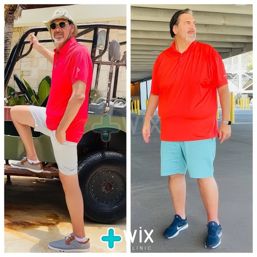 Gastric Sleeve Before and After 