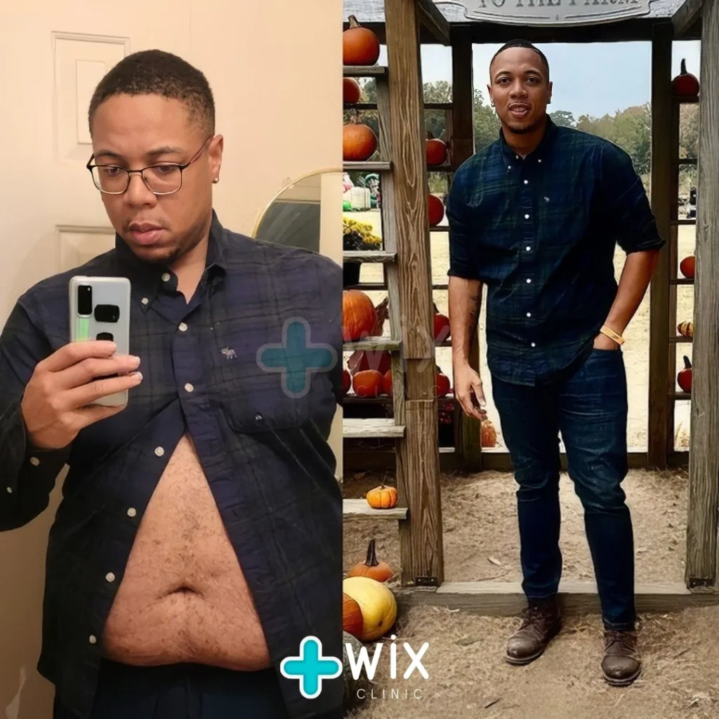 Gastric Sleeve Before and After 