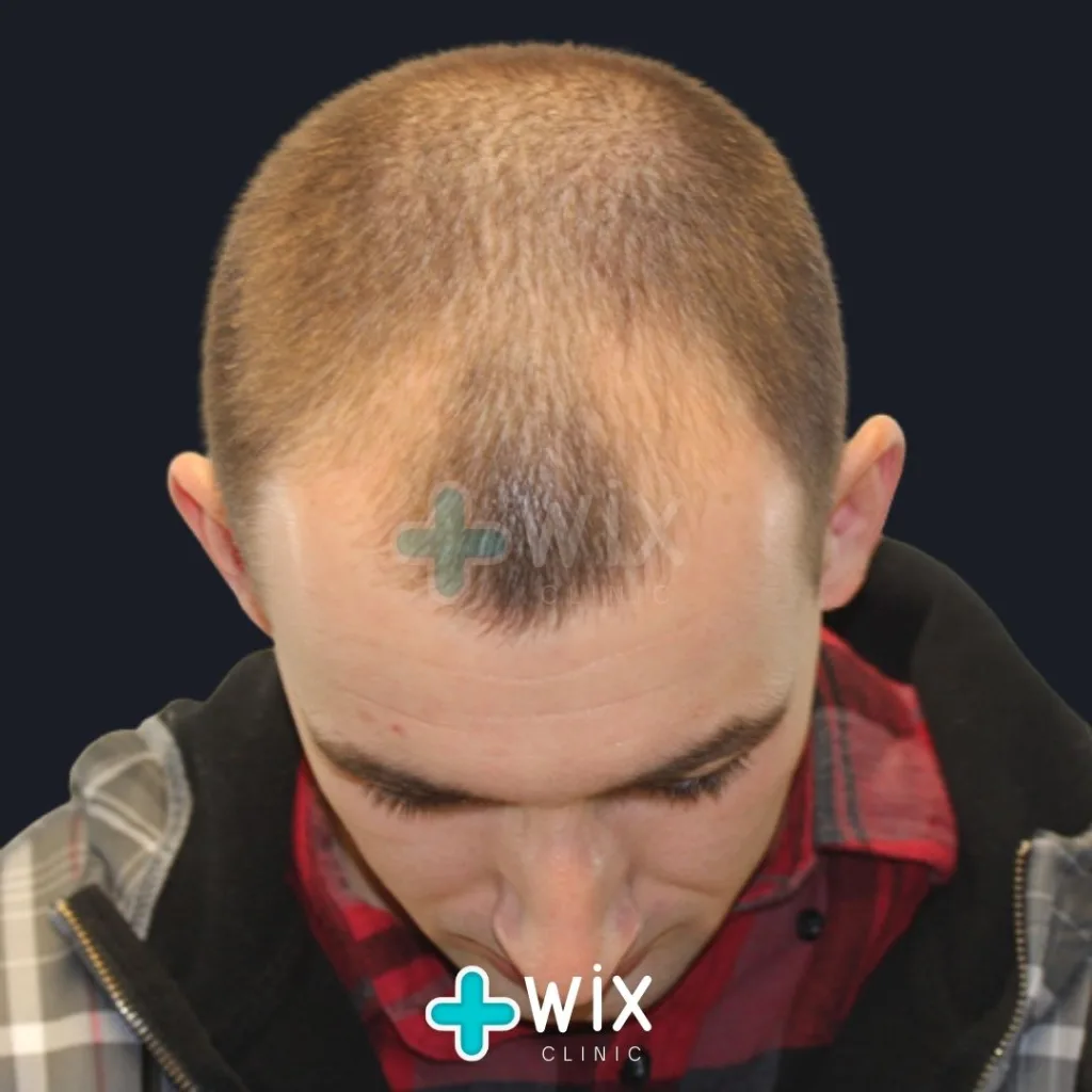 Hair Transplant Before and After