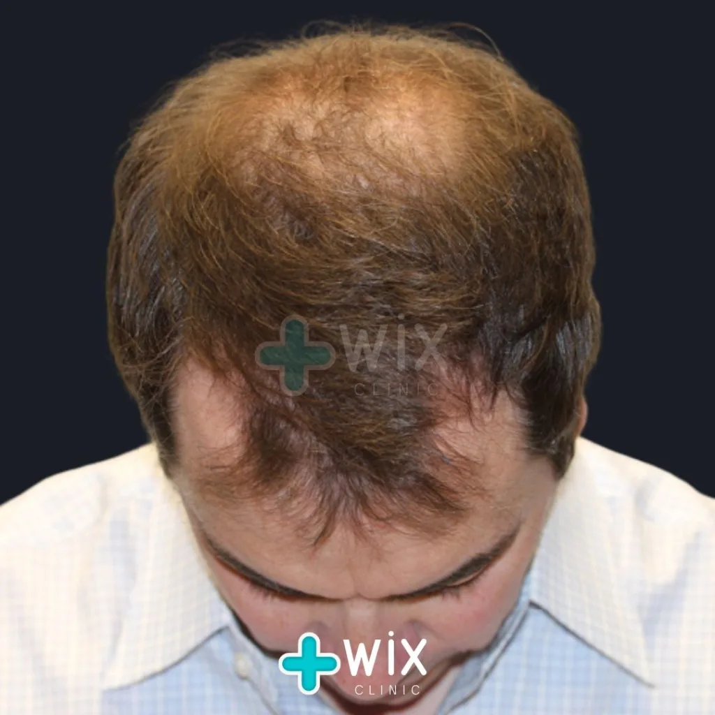 Hair Transplant Before and After