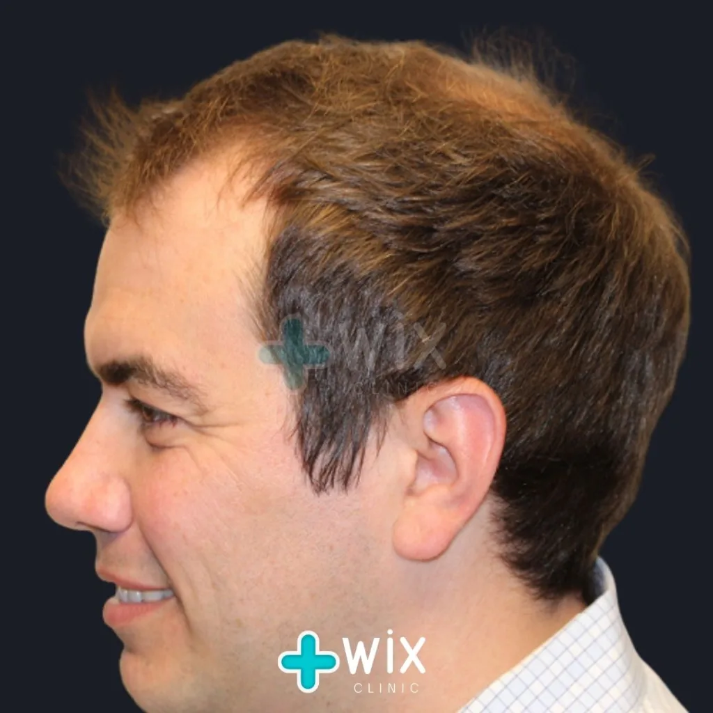 Hair Transplant Before and After