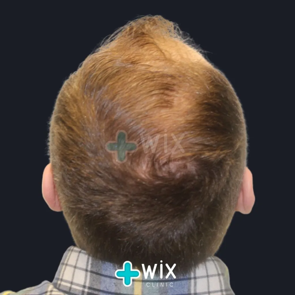 Hair Transplant Before and After