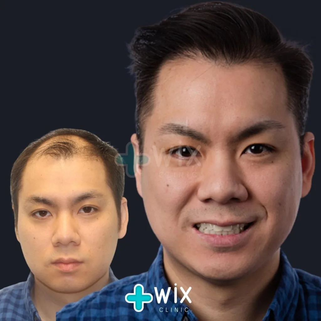 Hair Transplant Before and After