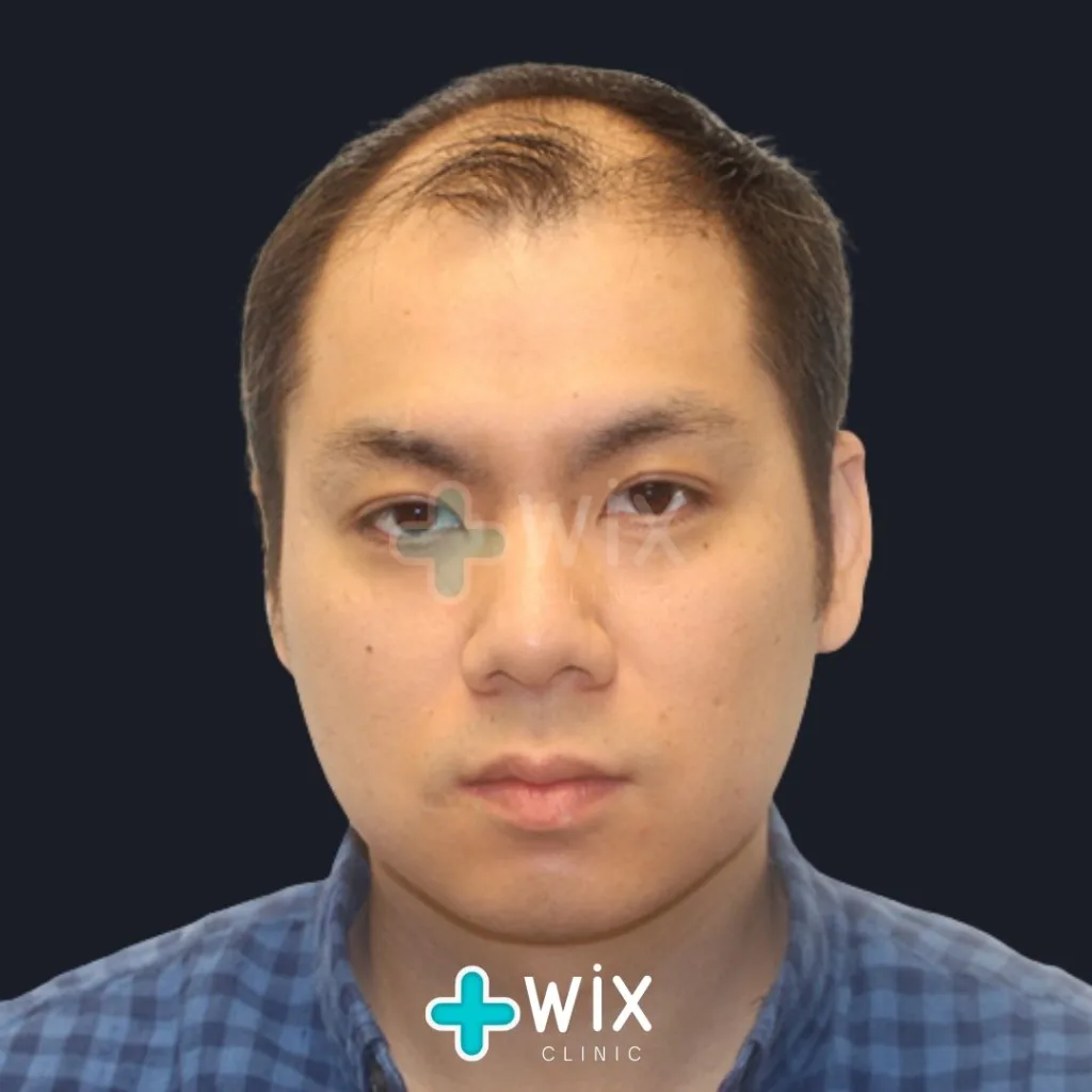 Hair Transplant Before and After