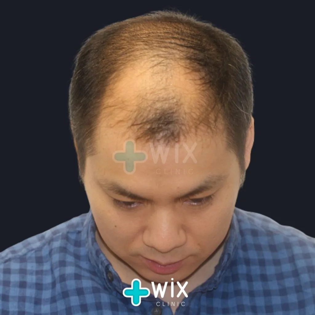 Hair Transplant Before and After