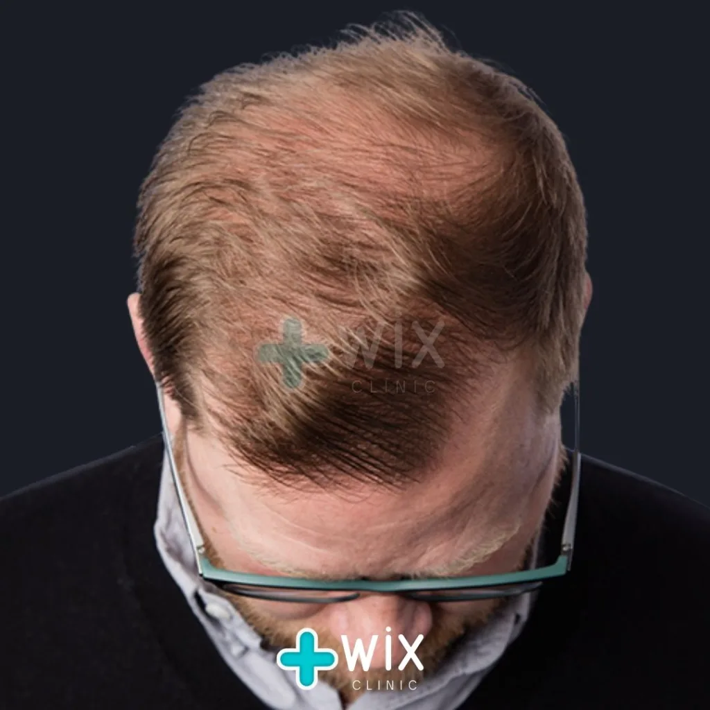 Hair Transplant Before and After