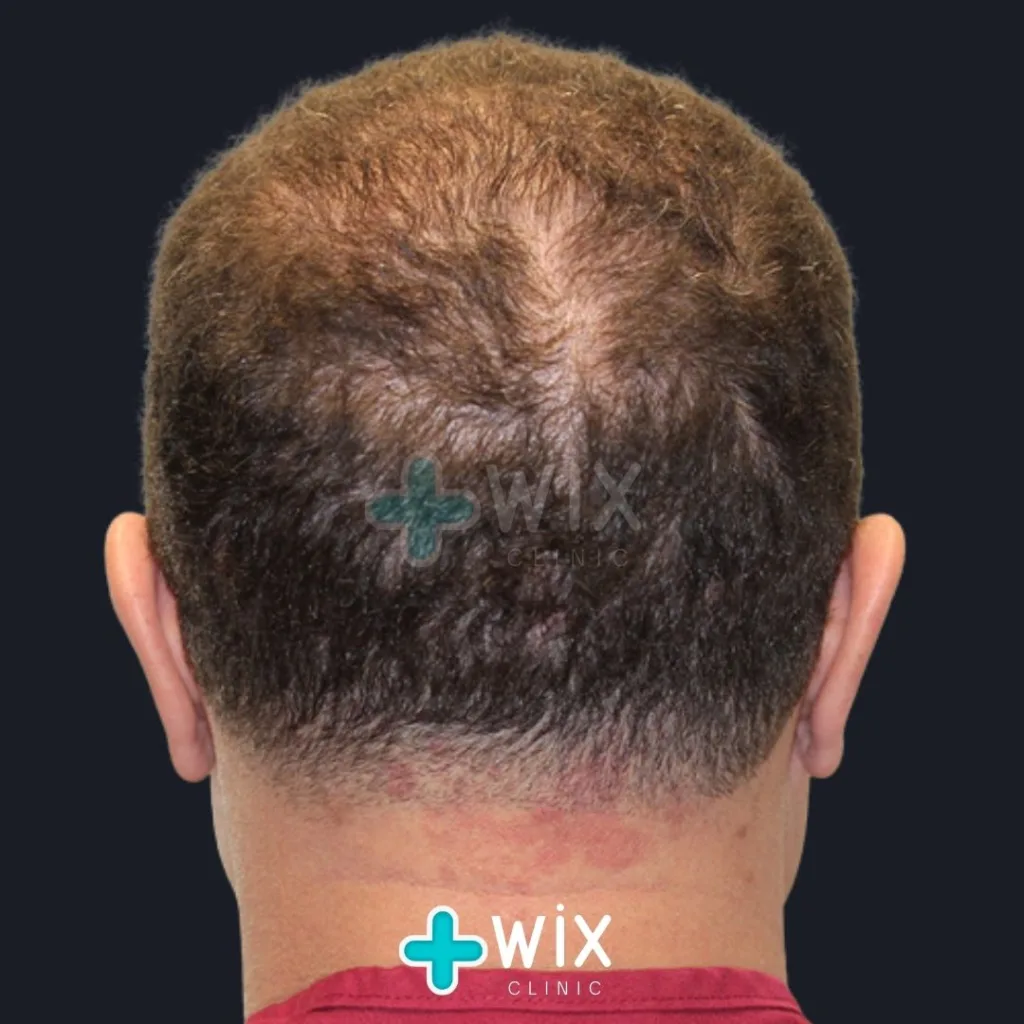 Hair Transplant Before and After