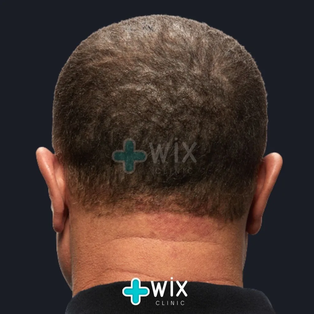 Hair Transplant Before and After