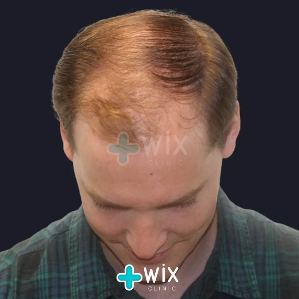 Hair Transplant Before and After