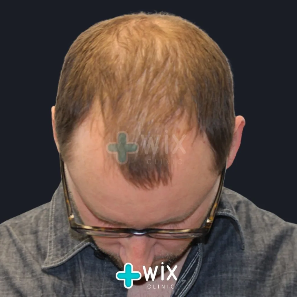 Hair Transplant Before and After