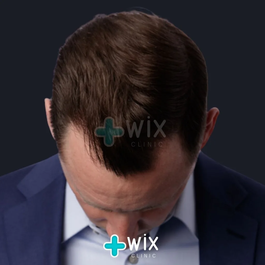 Hair Transplant Before and After