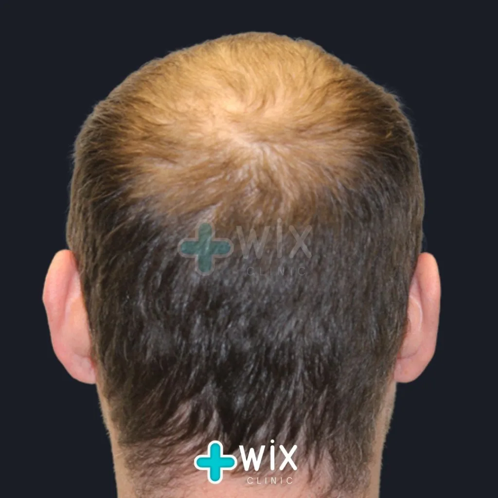 Hair Transplant Before and After