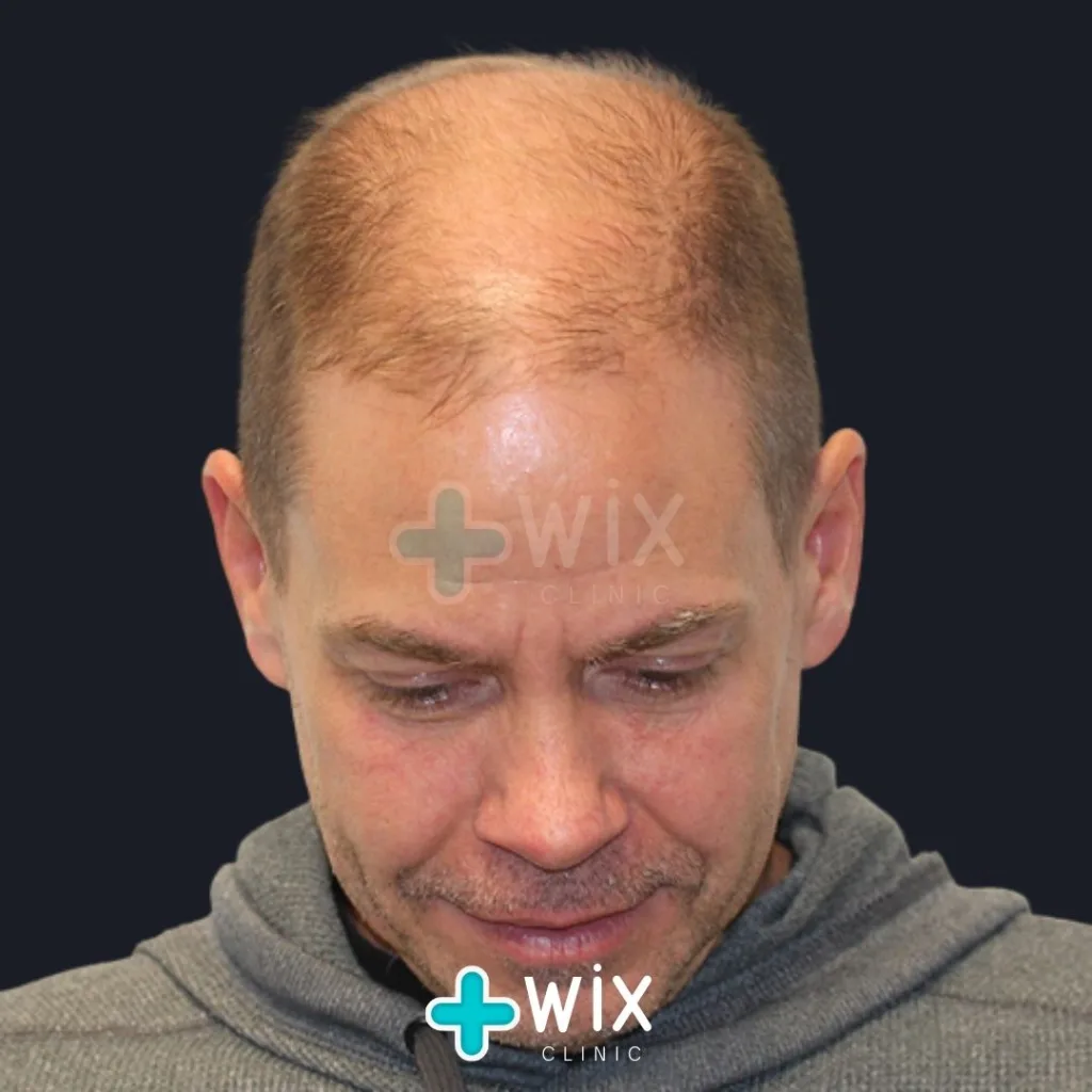 Hair Transplant Before and After