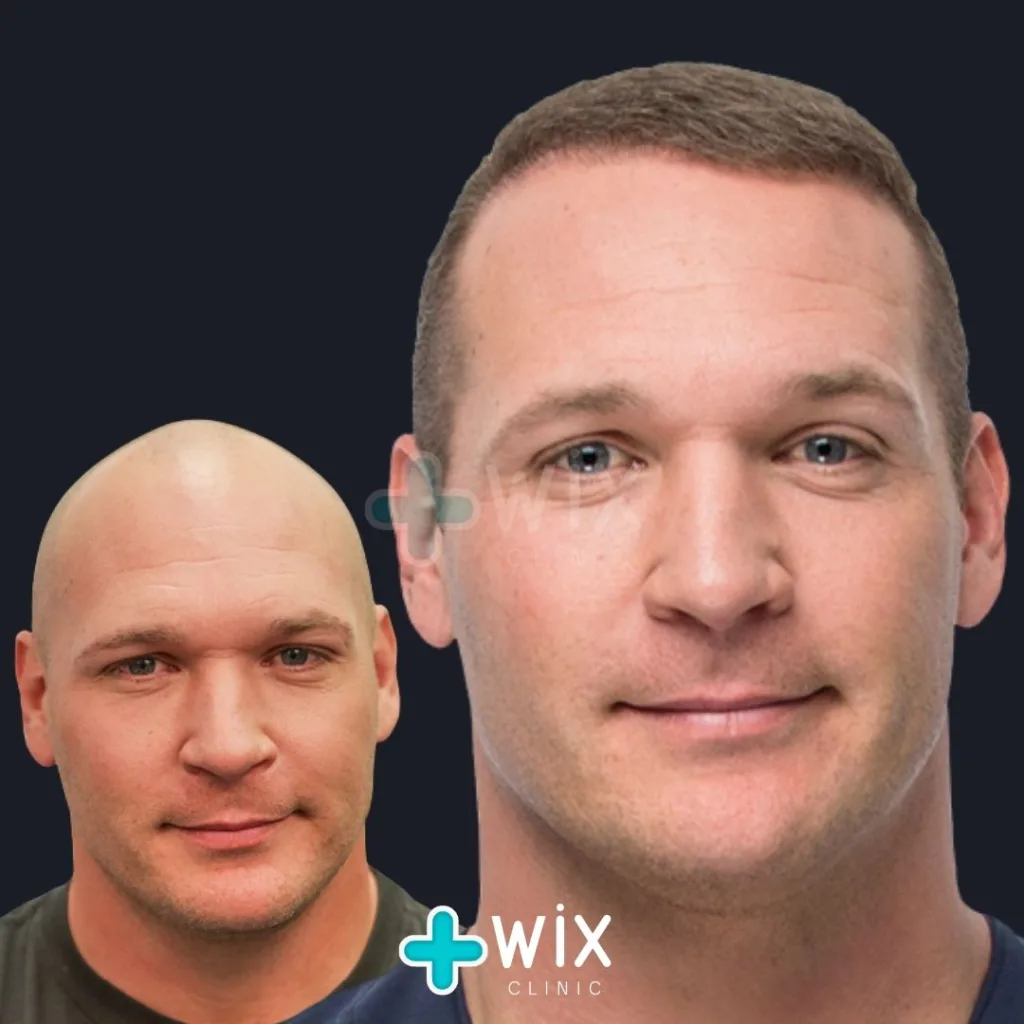 Hair Transplant Before and After