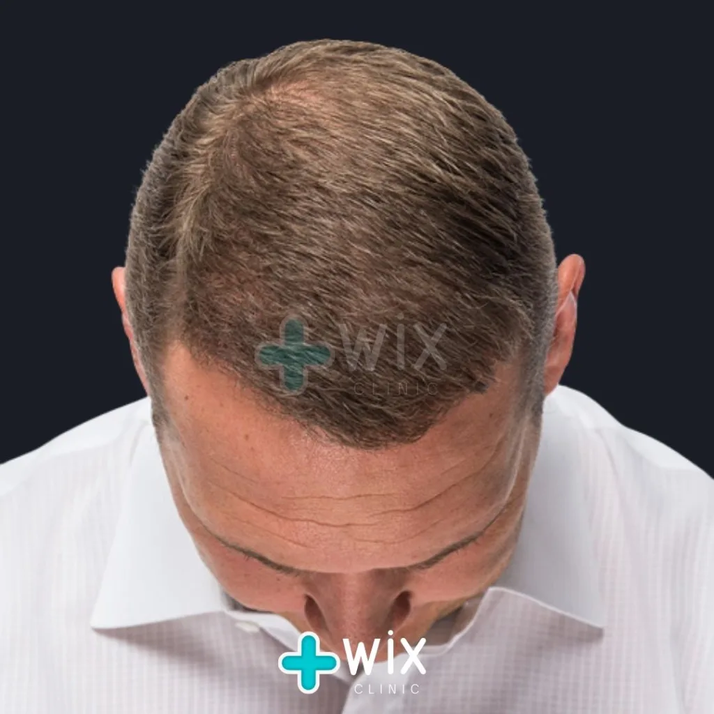 Hair Transplant Before and After