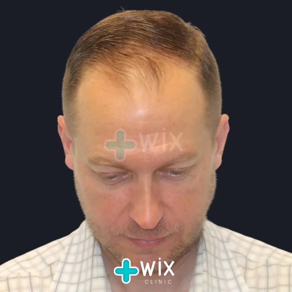 Hair Transplant Before and After