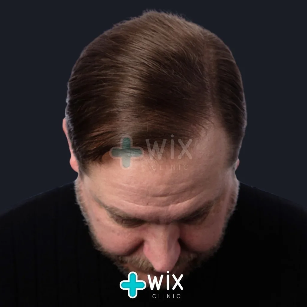 Hair Transplant Before and After