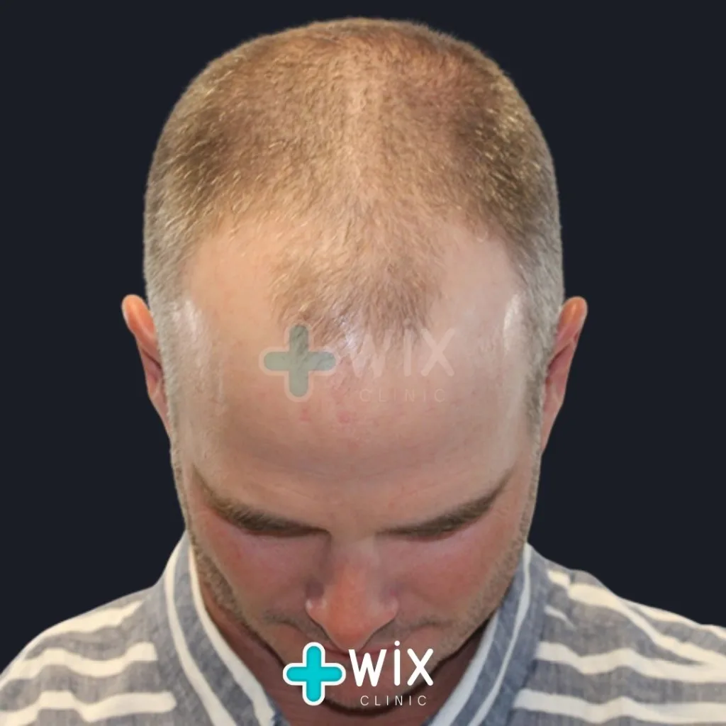 Hair Transplant Before and After