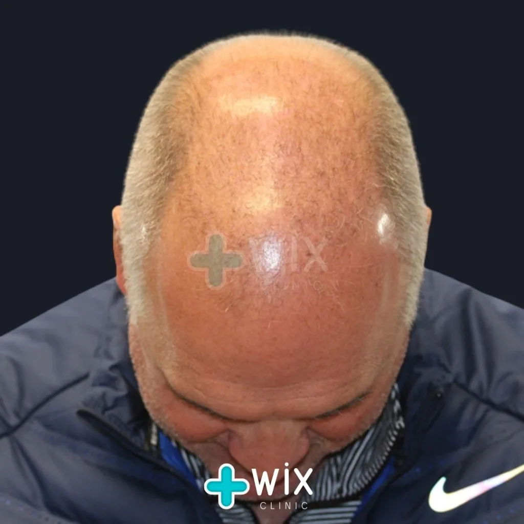 Hair Transplant Before and After