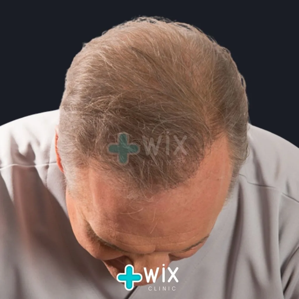 Hair Transplant Before and After