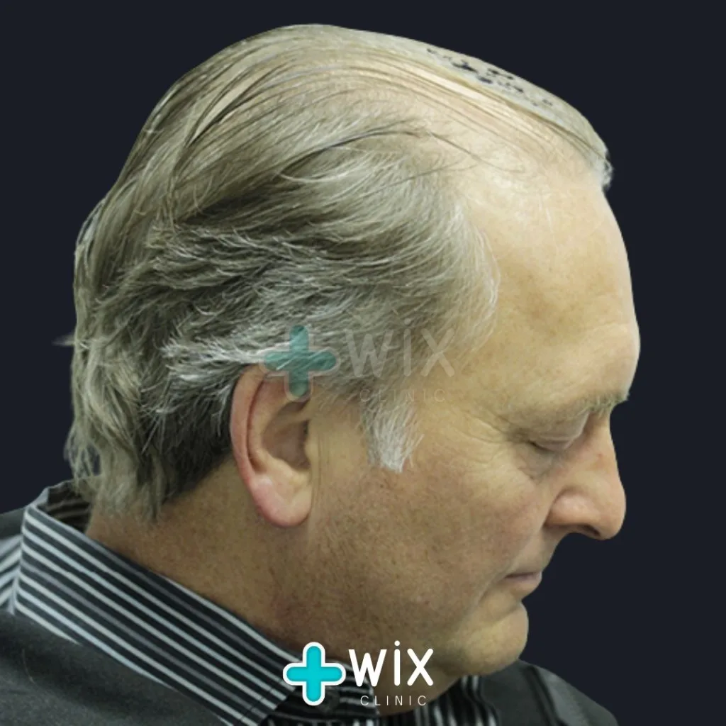 Hair Transplant Before and After